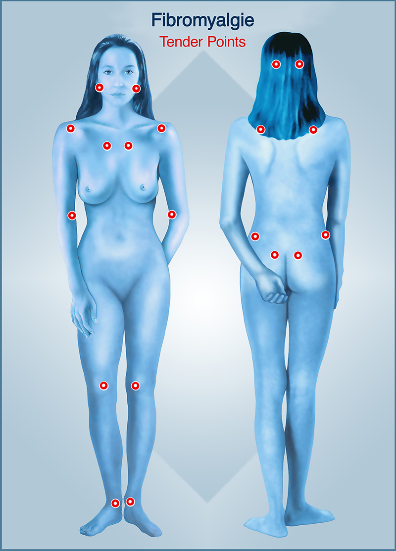 symptomes-tender-points-fibromyalgie
