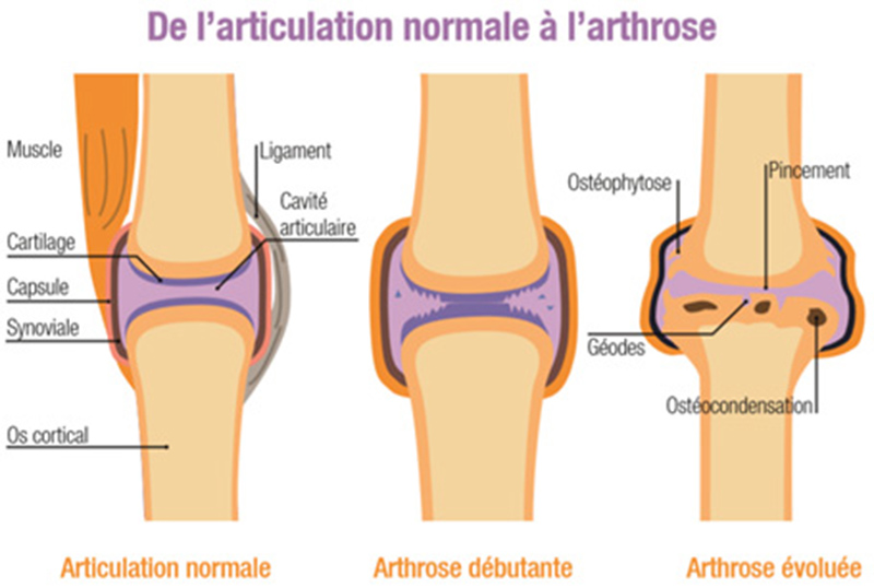 arthrose_schema