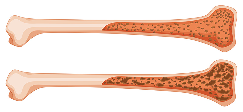 schema-os-avec-et-sans-osteoporose